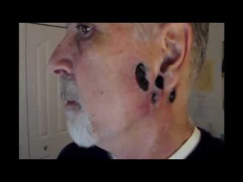 Black Salve Update April 1, 2013 -  More Chunks Came Out - Warning Graphic!