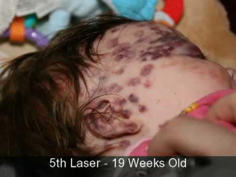 Sydney's Hemangiomas Laser Treatments and Propranolol