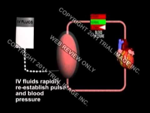 Shock - cardiac, septic, hypovolemic -  Trial Image Inc. Medical Animation by Cal Shipley, M.D. -