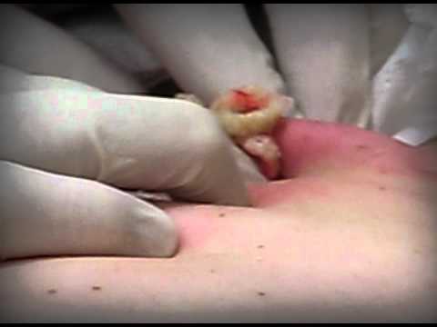 BIGGEST CYST ON THE PLANET  |  Operation 