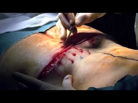 Excess Skin Operation - Embarrassing Bodies