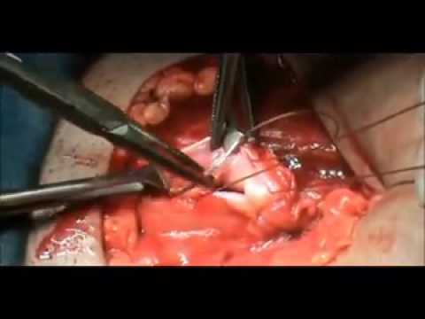 CESAREAN SECTION, step by step, by PROF  Dr  ARSHAD