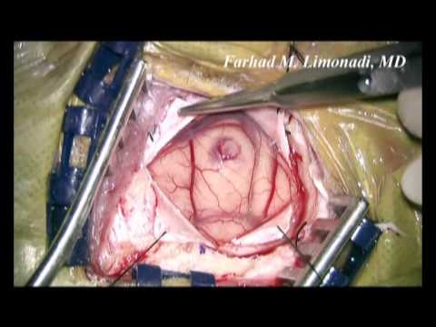 Surgical footage of removal of Glioblastoma Multiforme (GBM) Brain Tumor