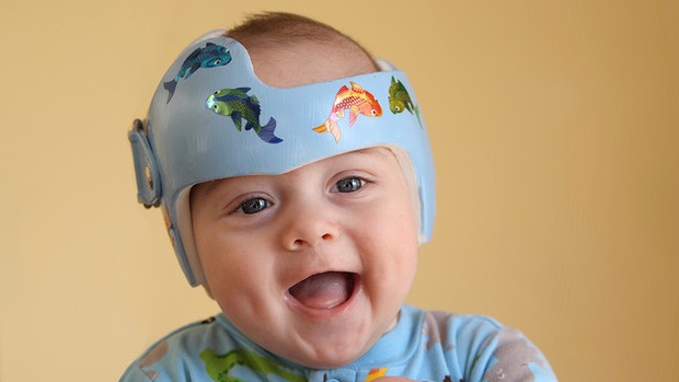 A baby wearing a helmet to correct plagiocephaly ('flat head syndrome').