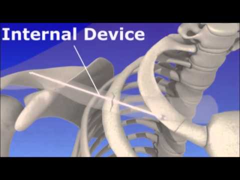 Clavicle Fracture - Broken Collar Bone