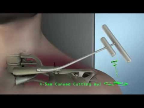 Clavicle Fracture Repair Device - Medical Videos