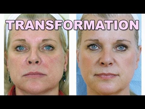 Janet Transformational- Dr. Lisa Airan - Dermatologist