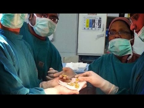 Gold Found in Man's Stomach!