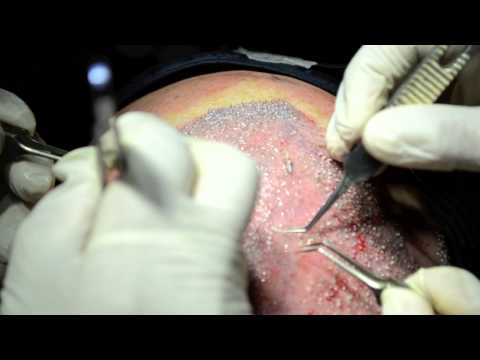 Hair Transplant Surgery - Full Procedure | HD