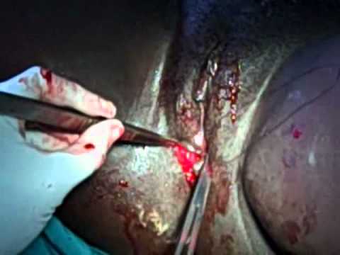 Episiotomy  Repair: Suturing of the muscle layer