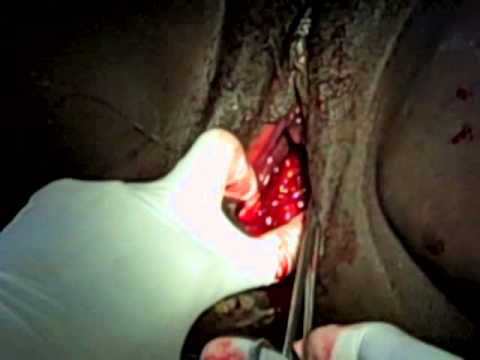 Episiotomy  Repair: Suturing of the vaginal mucosa