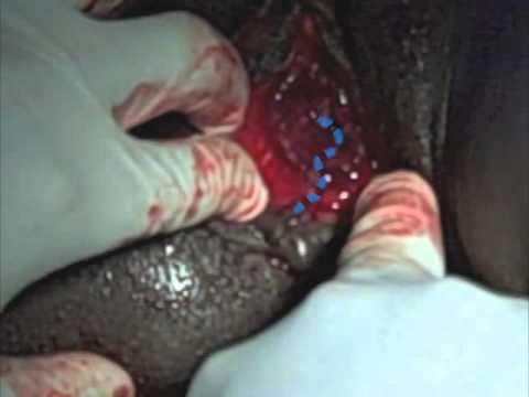 Episiotomy  Repair: Inspection of the repair