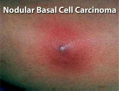 Understanding Basal Cell Carcinoma (Skin Cancer #4)