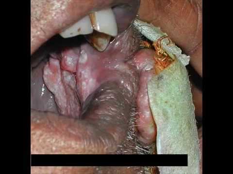 oral cancer, tobacco and smoking