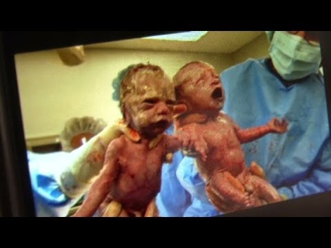 Mom delivers rare twins on Mother's Day