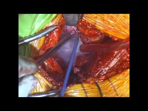 Total Hip Replacement - Surgical Procedure - HD