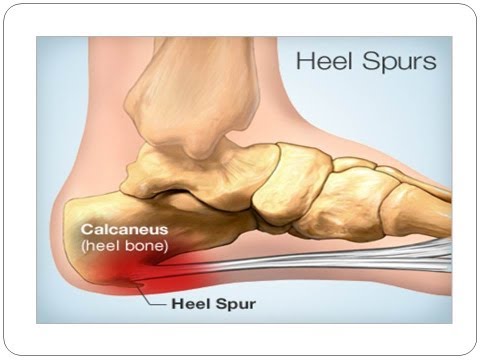 Pain in Heel of Foot | How to Get Rid of Foot Pain Caused by Heel Spurs or Pain in heel of foot