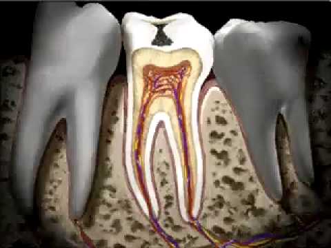 Medical Tourism in Croatia - Dental Health - Caries