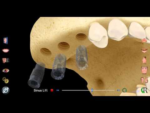 Houston TX Periodontist Shares Patient Education - Sinus Lift