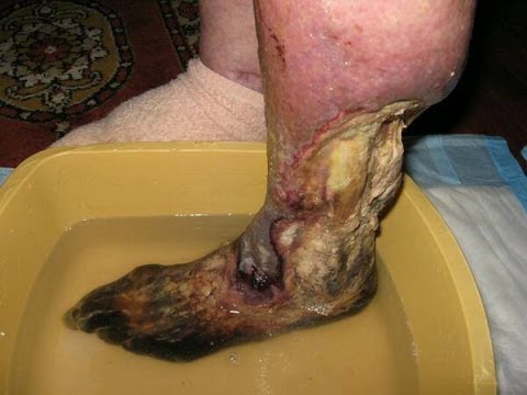 Krokodil: Highly Addictive Flesh-Eating 'Zombie Drug' Wreaks Havoc