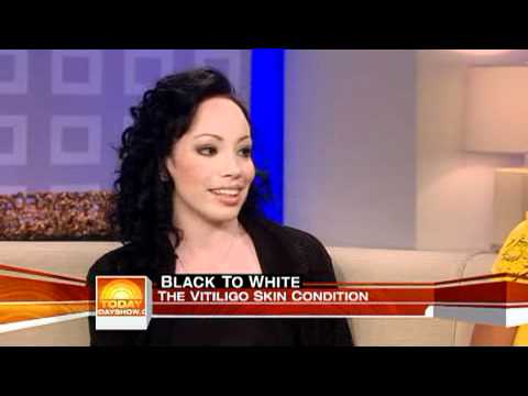 Girl with vitiligo talks about Michael Jackson