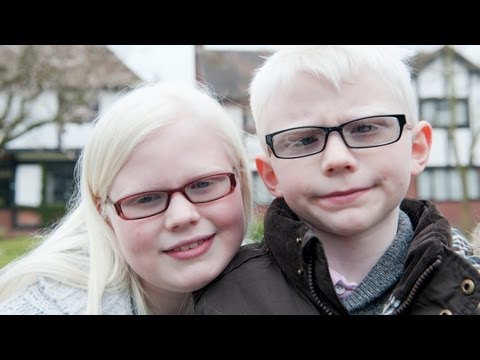 Albino Kids Won't Let Their Condition Hold Them Back