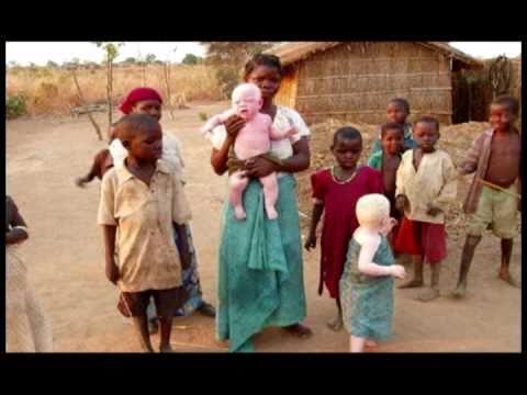 Albinos Africanos