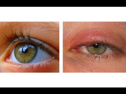 HOW TO CURE AN EYE INFECTION IN 24 HOURS!