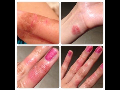 How to: Cure Hand Eczema / Dermatitis Effectively!!