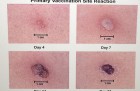 Images of different stages of sore and eventual scarring caused by the smallpox vaccination is shown at Mid-Florida Biologicals December 5, 2002 in Altamonte Springs, Florida. (Photo by Scott A. Miller/Getty Images)