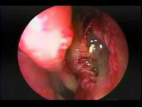 Maxillary Sinus Mucocoele Hawke MD