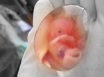 File:Human fetus 10 weeks - therapeutic abortion.jpg