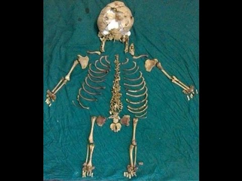 Doctors in Maharashtra have removed the skeleton of a foetus that had been inside a woman for 36 years in what is believed to be the world\'s longest ectopic pregnancy, a doctor has said.

Skeletal remains that were removed are seen in video footage laid out on a hospital bed, and include numerous parts of a rib cage, leg and arm bones and sections of a skull, spine and pelvis. 

The 60-year-old woman became pregnant at the age of 24 but suffered a miscarriage because the foetus had been growing outside of her uterus, the doctor told news agency AFP on Monday. 

The woman was \