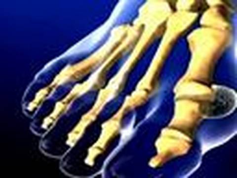 Body Invaders: Gout