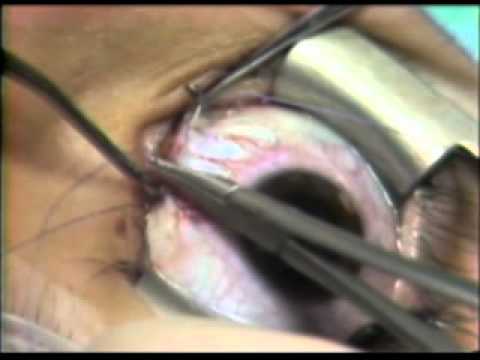 Strabismus Surgery: Medial Rectus Recession - Limbal Approach