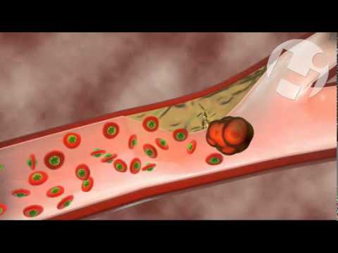 The Effect of Aspirin on Clot Formation