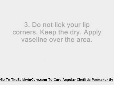 Angular Cheilitis Emedicine - Just What You've Been Looking For