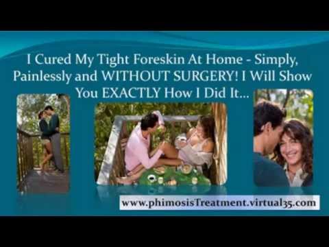 phimosis treatment emedicine - phimosis treatment options