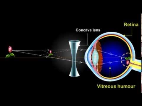 what is myopia??? (Short Sightedness)