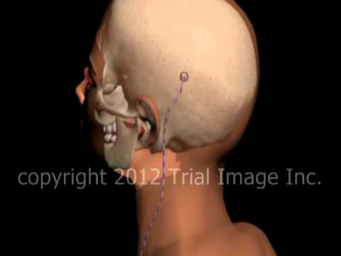 Hydrocephalus shunt video - Trial Image Inc. Animation by Cal Shipley, M.D.