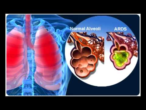 Acute Respiratory Distress Syndrome (ARDS)