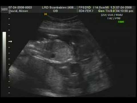 ultrasound at 18 weeks, surprise! its twins!