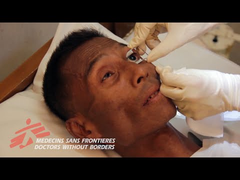 Myanmar - HIV-Related Blindness