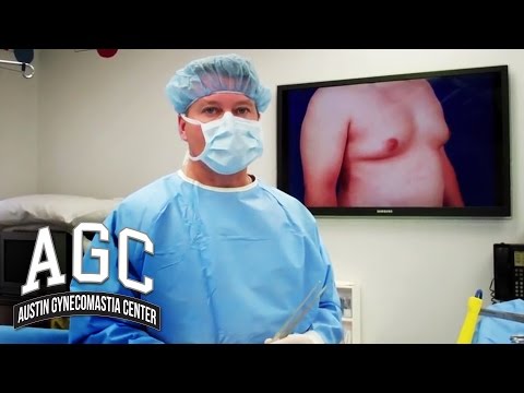 Gynecomastia Liposuction vs Excision - Westlake Plastic Surgery