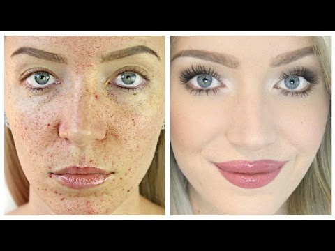 Acne Coverage Foundation Routine (Acne Scarring + Pigmentation)