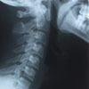 What is Subluxation? Thumbnail Image