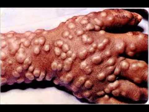 Smallpox