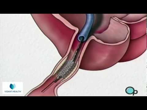 Stent Implantation Coronary Angioplasty Vidant PreOp® Patient Education