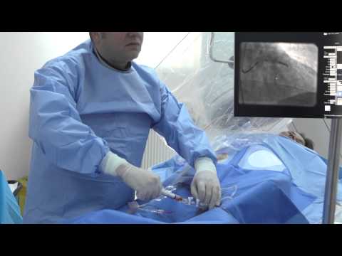 ARES | Angioplastie coronariana cu stent bioresorbabil Absorb | Dr. Roberto Haret