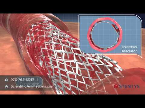 3D Animation of Coronary Stent Procedure